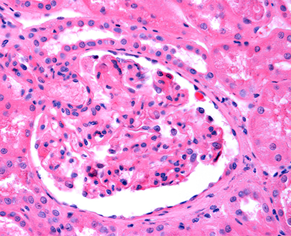 Glomerulonephritis scan